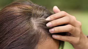 going gray in 20s