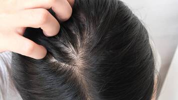 photo of womans scalp minoxidil