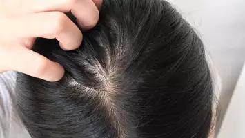 photo of womans scalp minoxidil