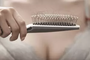 Photo of hair brush with lots of hair due to thinning hair