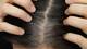 photo of grey hair growing into scalp