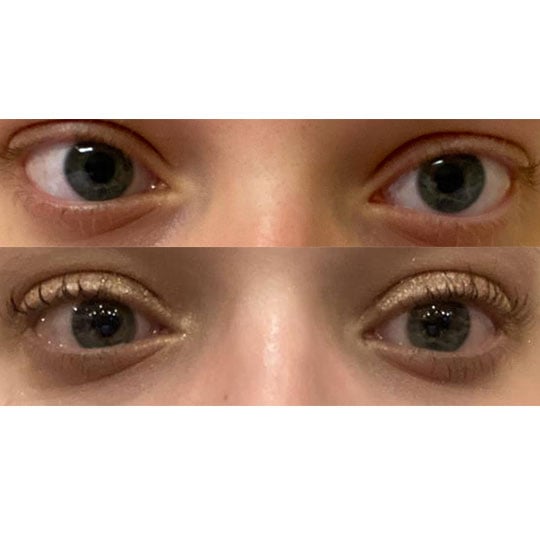 trichotillomania